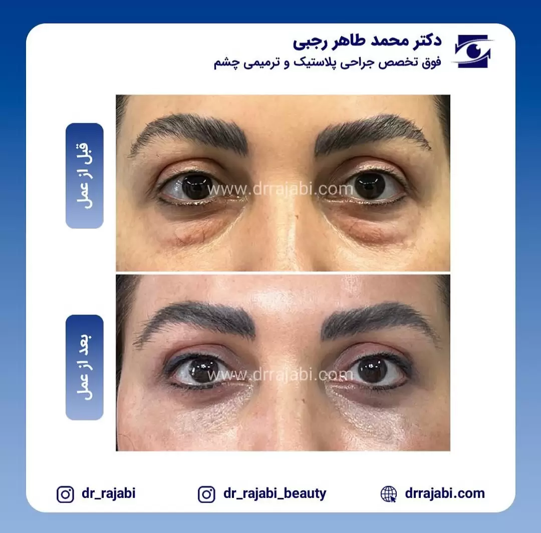 جراحی بلفاروپلاستی پلک پایین بدون بخیه